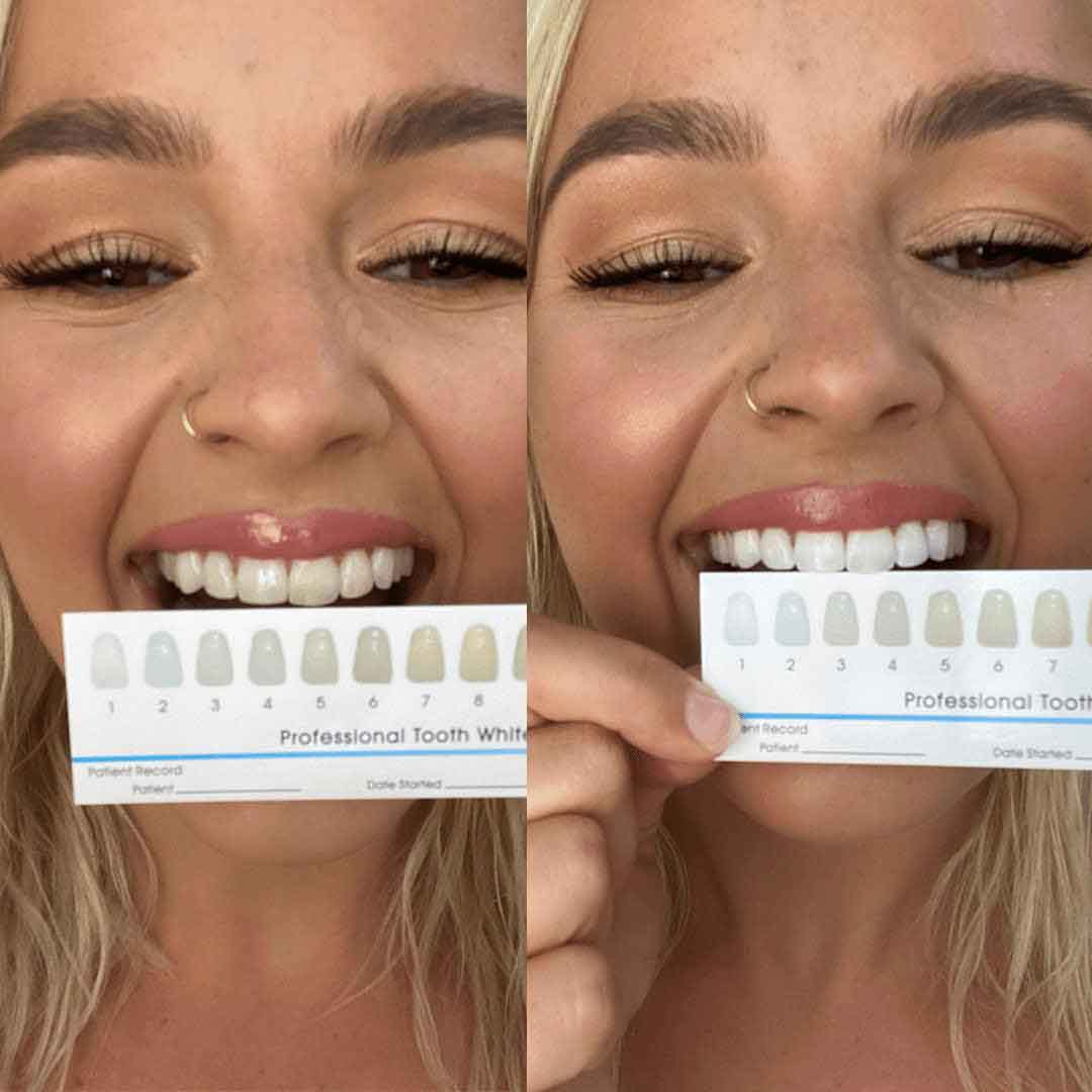 BrightSmile Home Whitening Kit